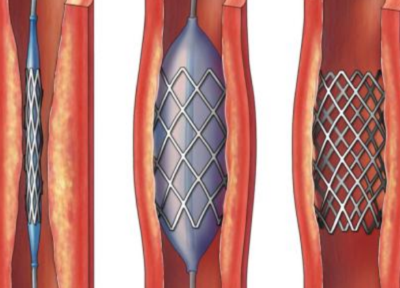 好消息！700元冠脈支架來(lái)了帶量采購(gòu)結(jié)果在甘肅省正式落地執(zhí)行